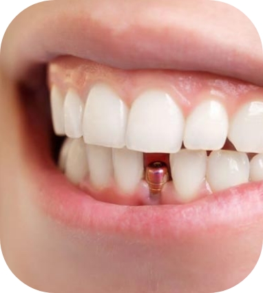 Single dental implant clinic Warrington