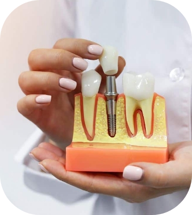 Single dental implant dentist Warrington