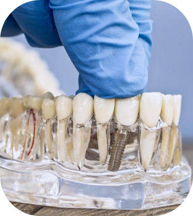 top Single dental implant dentist Warrington