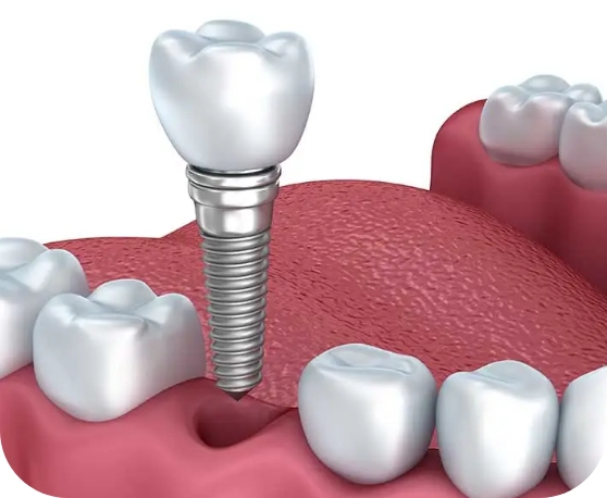 Single dental implant dentist Warrington