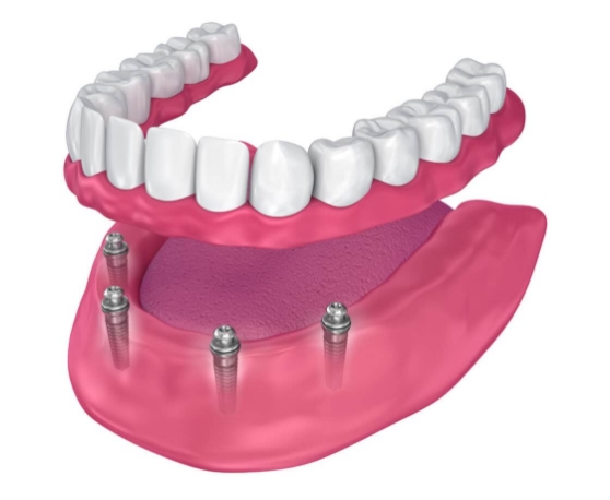 All On 4 Dental Implants Warrington