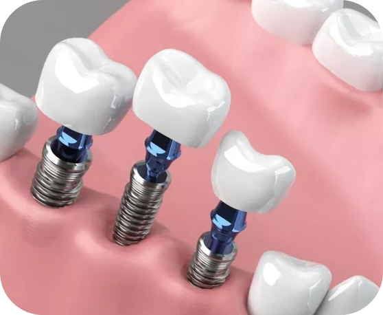Multiple Dental Implants in Warrington