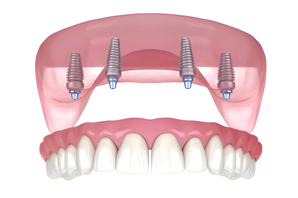 All-on-4 Dental Implants