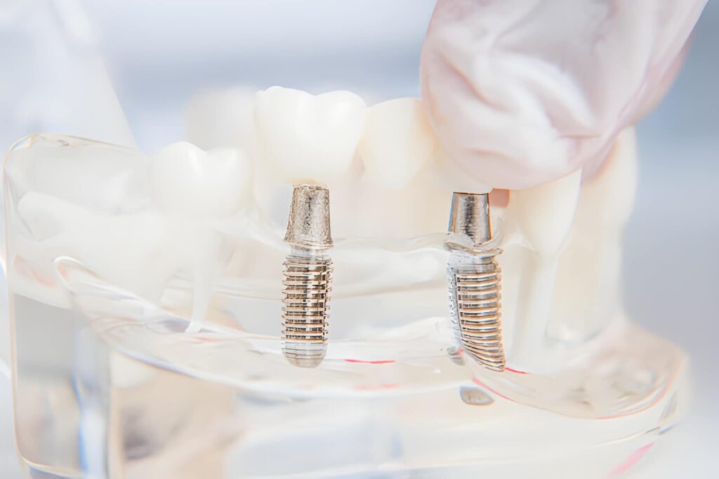 dental implants