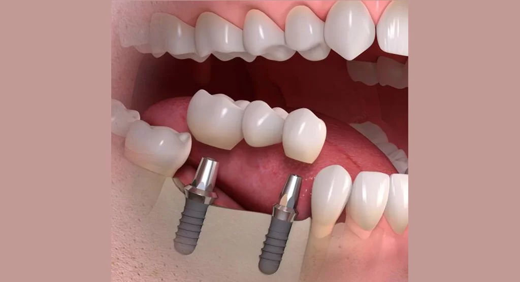 Dental Implant