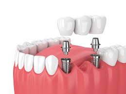 dental implant in the UK