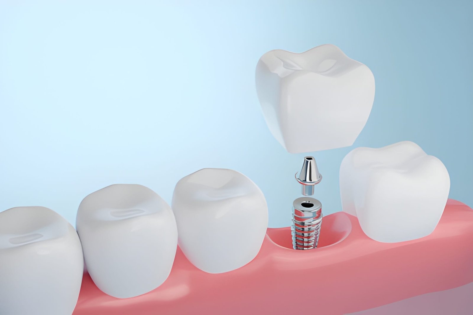 Dental Implants in Warrington