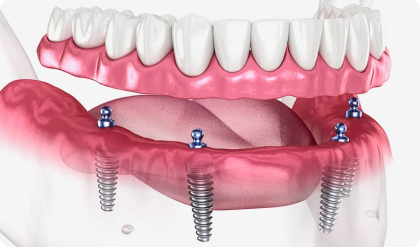 Dental Implant