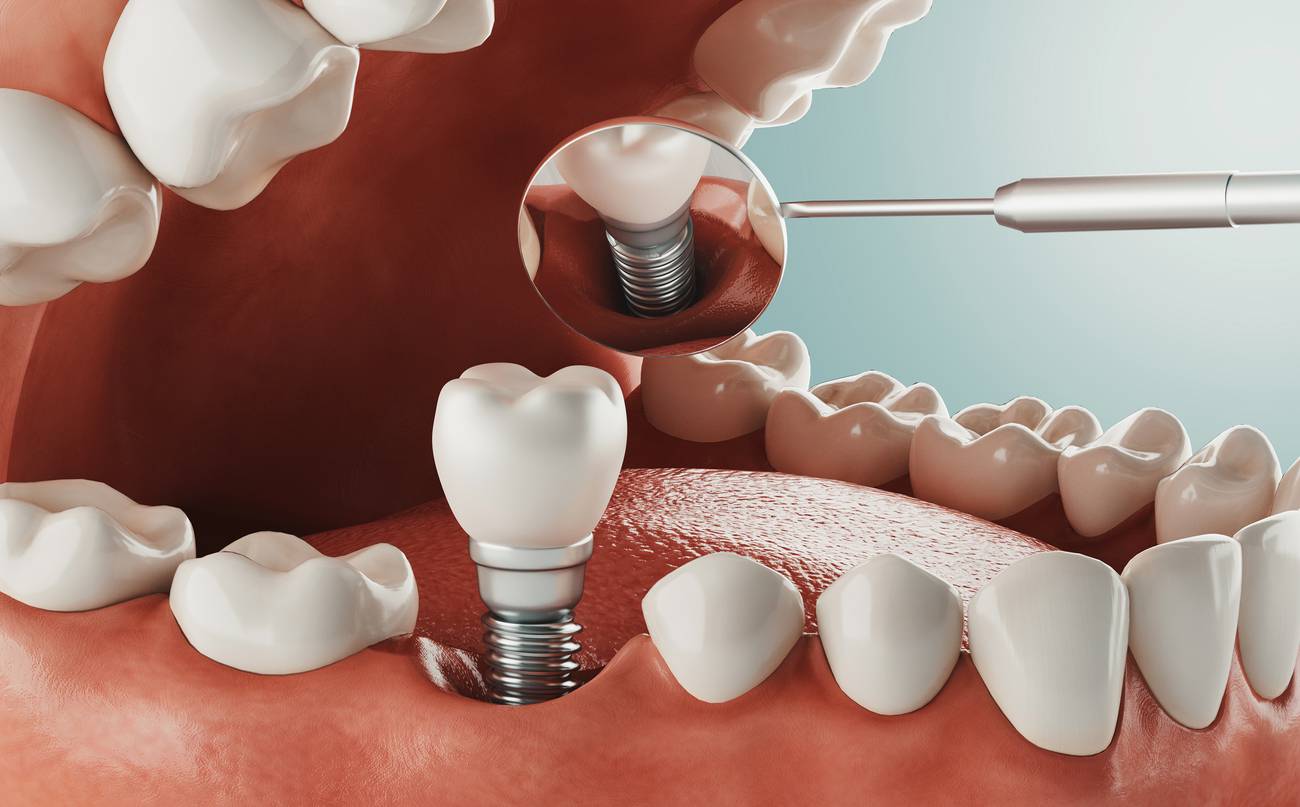 one Dental Implant in the UK