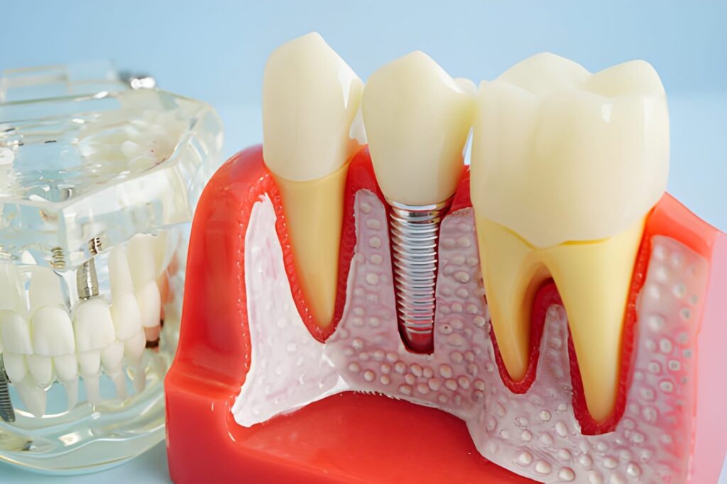 Dental Implant Replace in Warrington