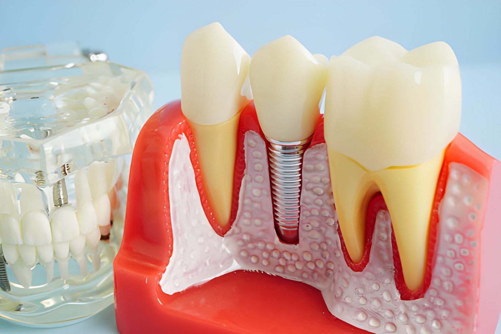 Dental Implant Replace in Warrington
