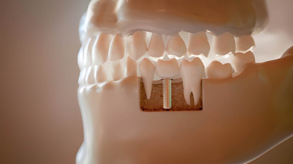 Warrington Dental Implant Centre