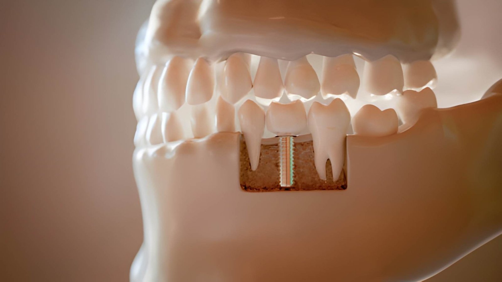 Warrington Dental Implant Centre