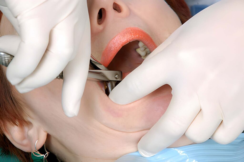 Tooth Extraction