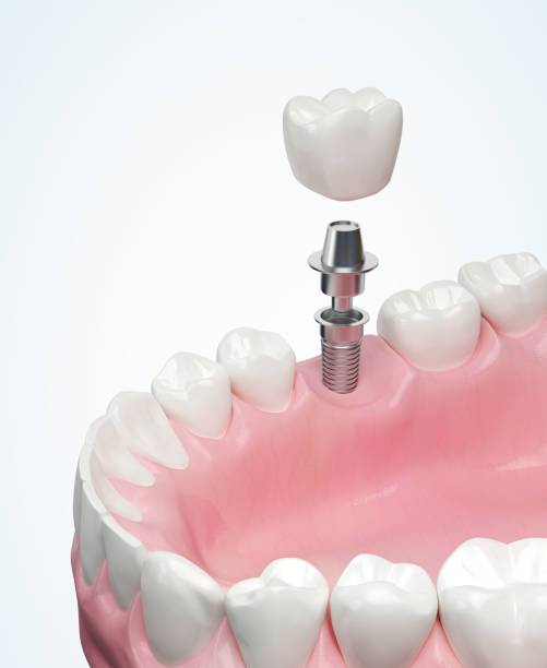 Tooth Implant