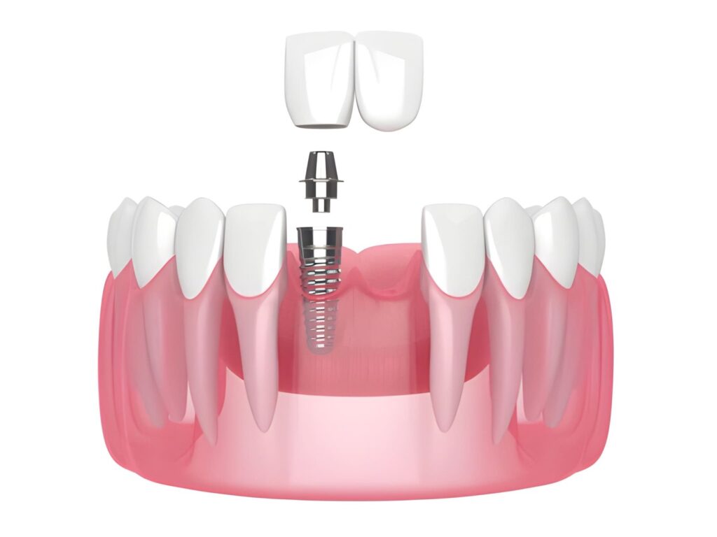 Tooth Implant